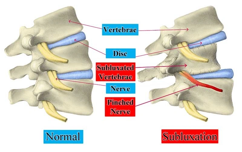 Spinal health education diagram explaining what is a subluxation and nervous system chiropractic care at Life is Good Chiropractic.
