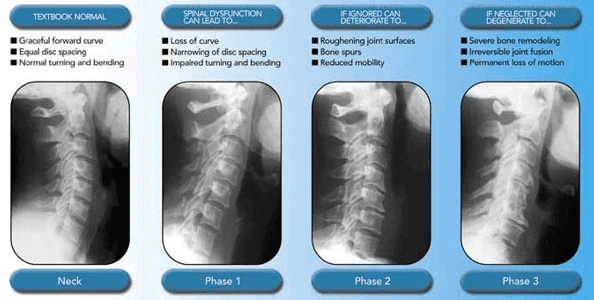 life is good chiropractic chiropractor brodheadsville PA about subluxations 4